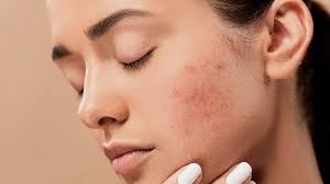 7 tác dụng phụ thường gặp khi sử dụng retinol và cách phòng ngừa